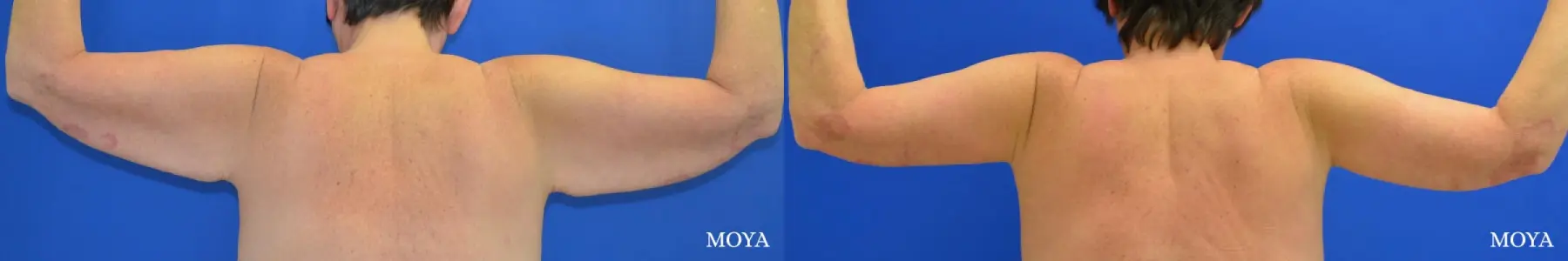 Arm Lift (MAJOR: inseam) - Before and After 2