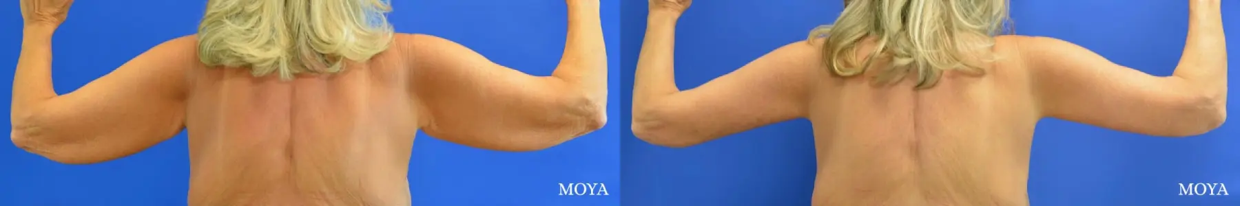 Arm Lift (MAJOR: inseam) - Before and After 2