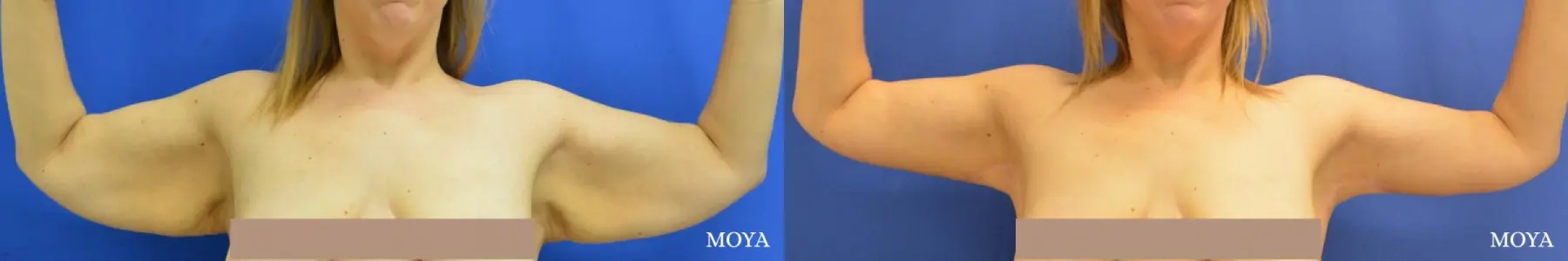 Arm Lift (MAJOR: posterior) - Before and After 1