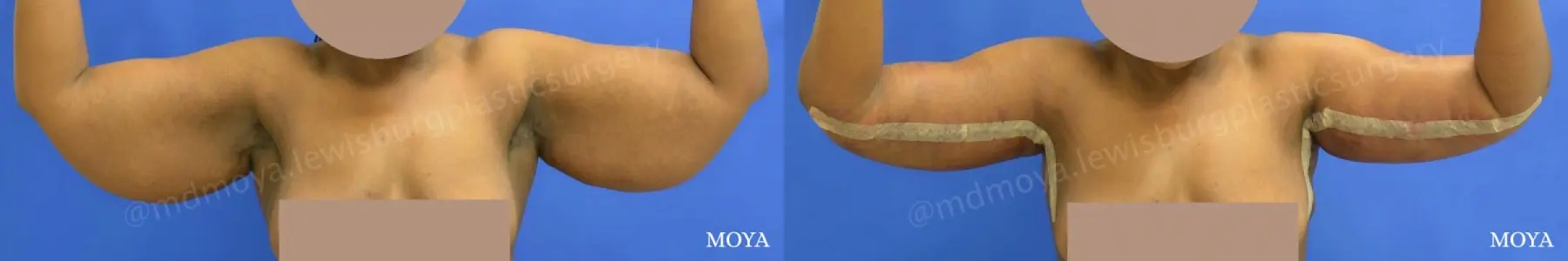 Arm Lift (MAJOR: inseam) - Before and After  