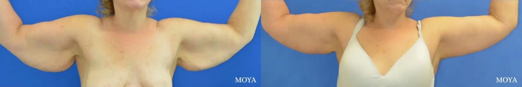 Arm Lift (MAJOR: posterior) - Before and After  