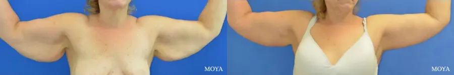 Arm Lift (MAJOR: posterior) - Before and After  