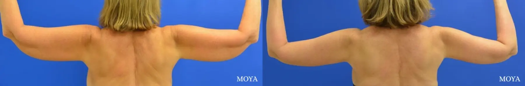 Arm Lift (MAJOR: inseam) - Before and After 2