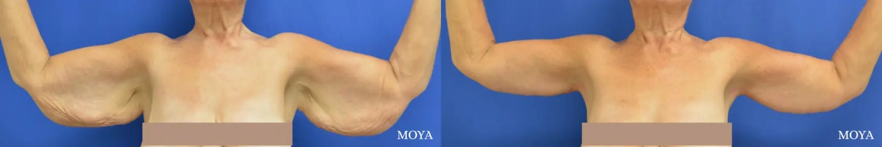 Arm Lift (MAJOR: posterior) - Before and After  