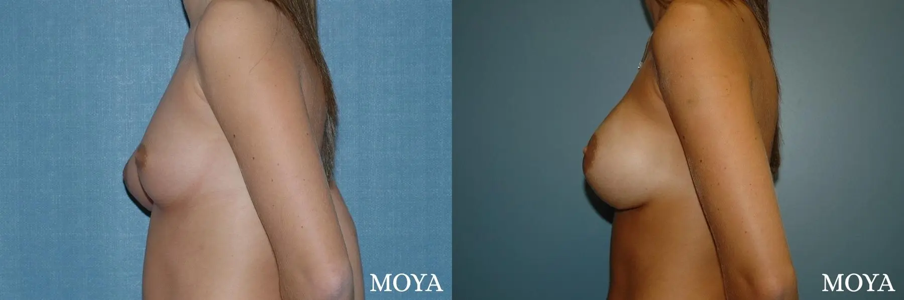 Breast Asymmetry: Patient 1 - Before and After 3