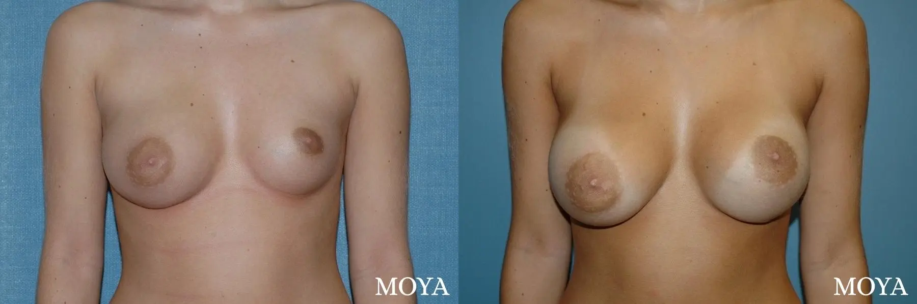 Breast Asymmetry: Patient 1 - Before and After 1