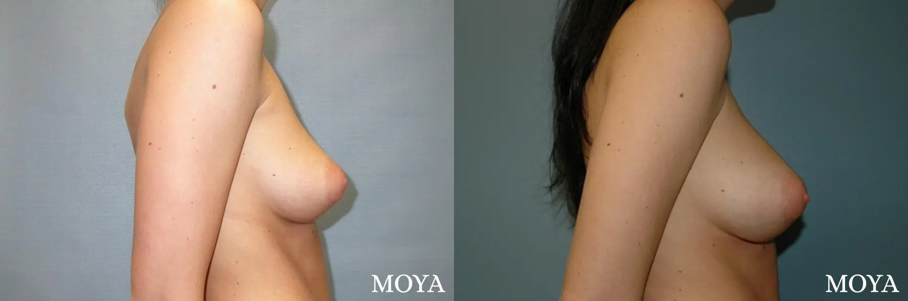 Breast Asymmetry: Patient 2 - Before and After 2