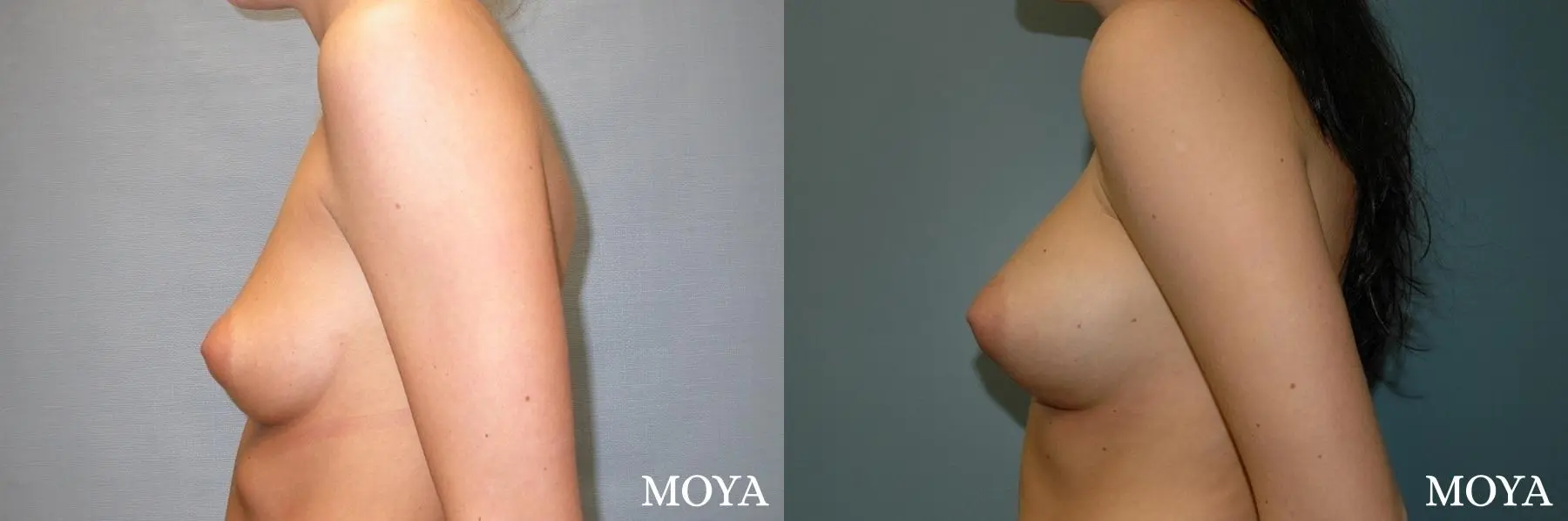 Breast Asymmetry: Patient 2 - Before and After 3