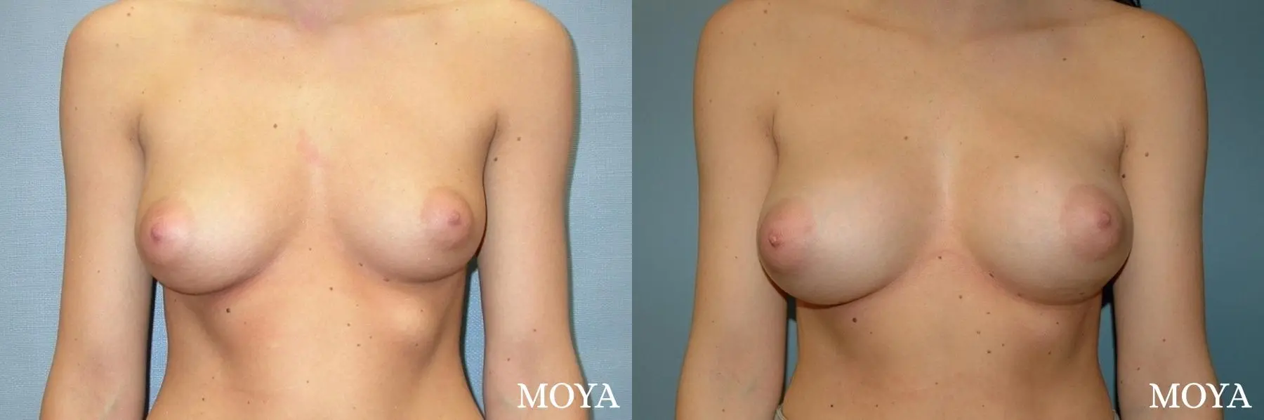 Breast Asymmetry: Patient 2 - Before and After 1