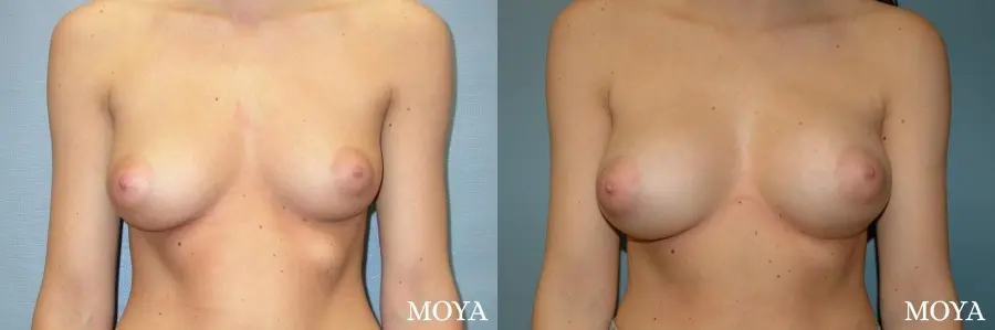 Breast Asymmetry: Patient 2 - Before and After  