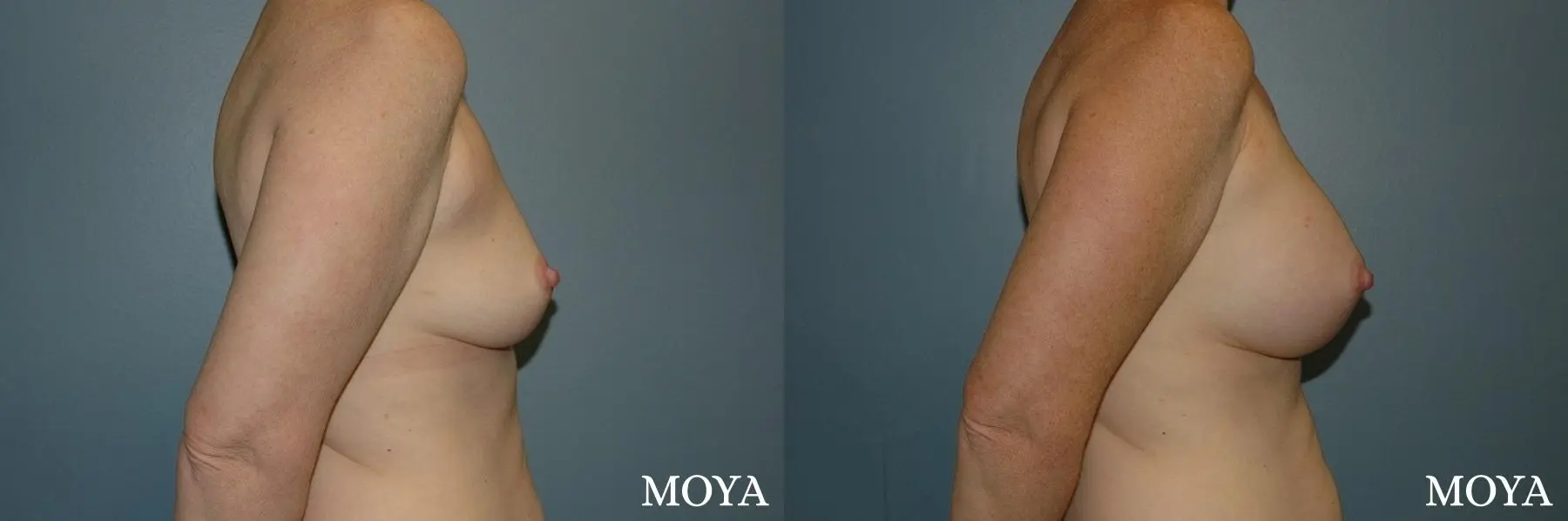 Breast Augmentation: Patient 11 - Before and After 2