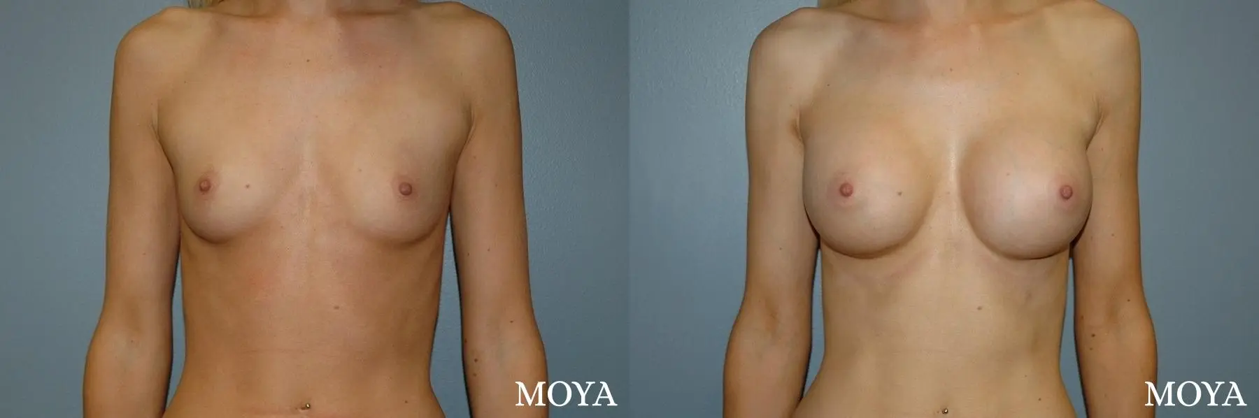 Breast Augmentation: Patient 7 - Before and After 1