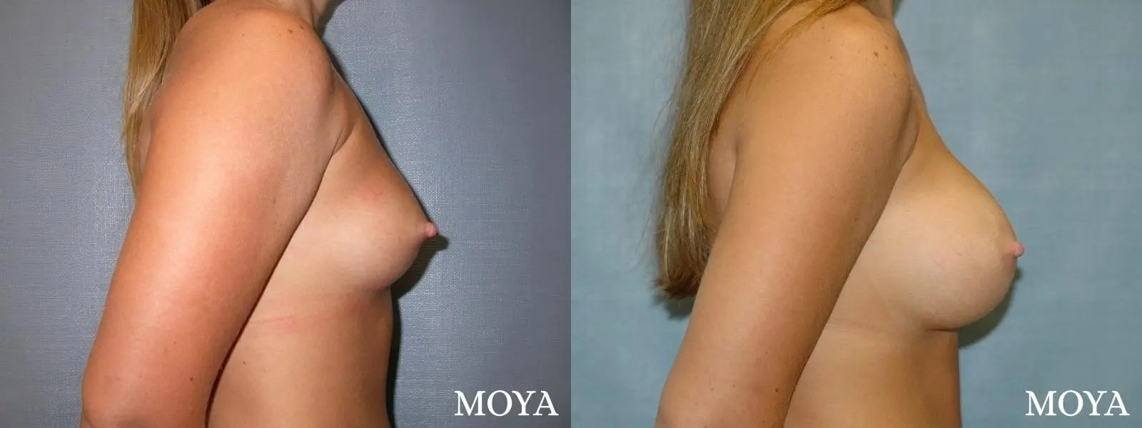 Breast Augmentation: Patient 2 - Before and After 2