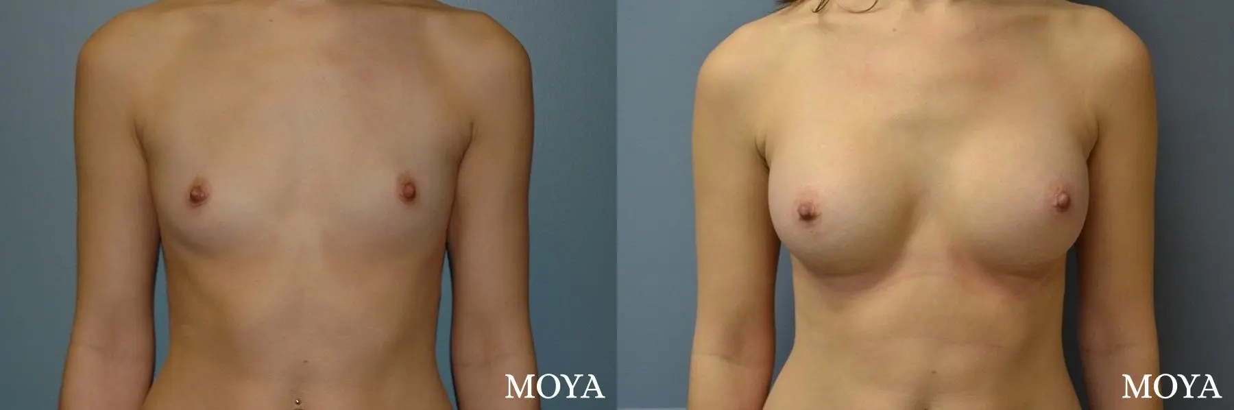 Breast Augmentation: Patient 9 - Before and After 1