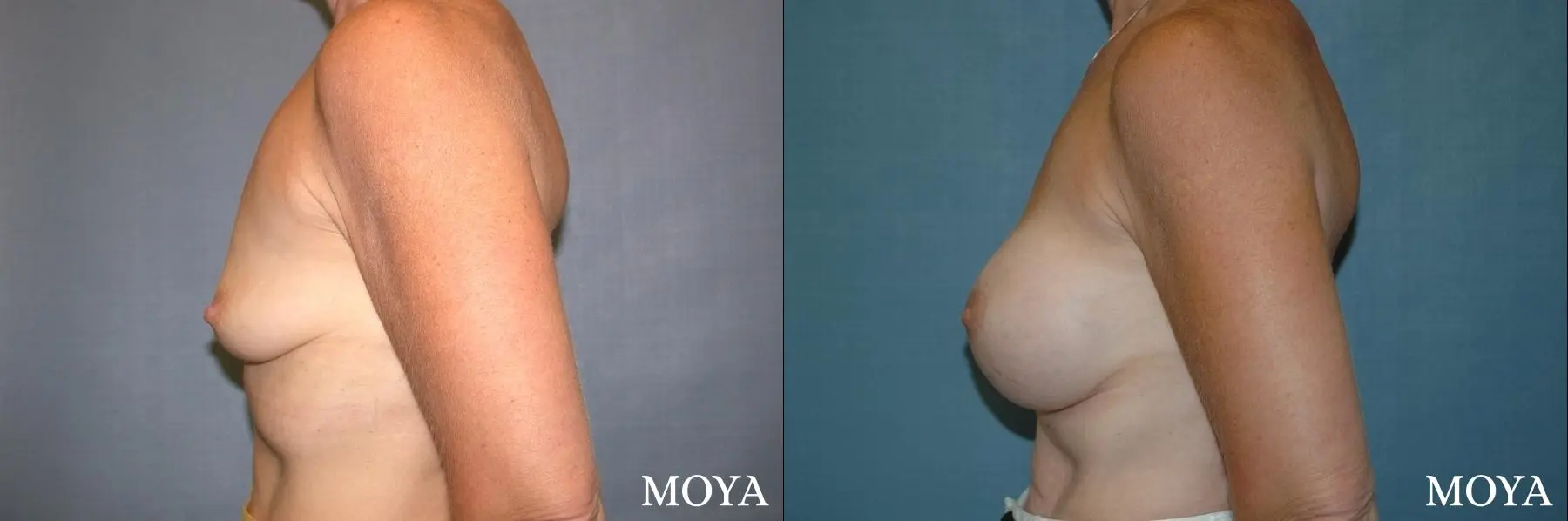 Breast Augmentation: Patient 4 - Before and After 2