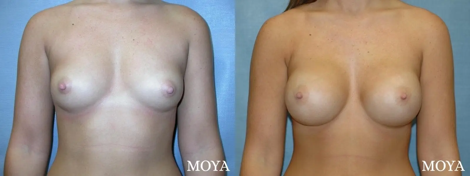 Breast Augmentation: Patient 2 - Before and After 1