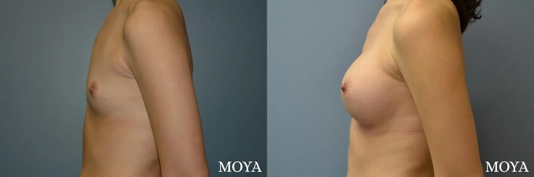 Breast Augmentation: Patient 9 - Before and After 2