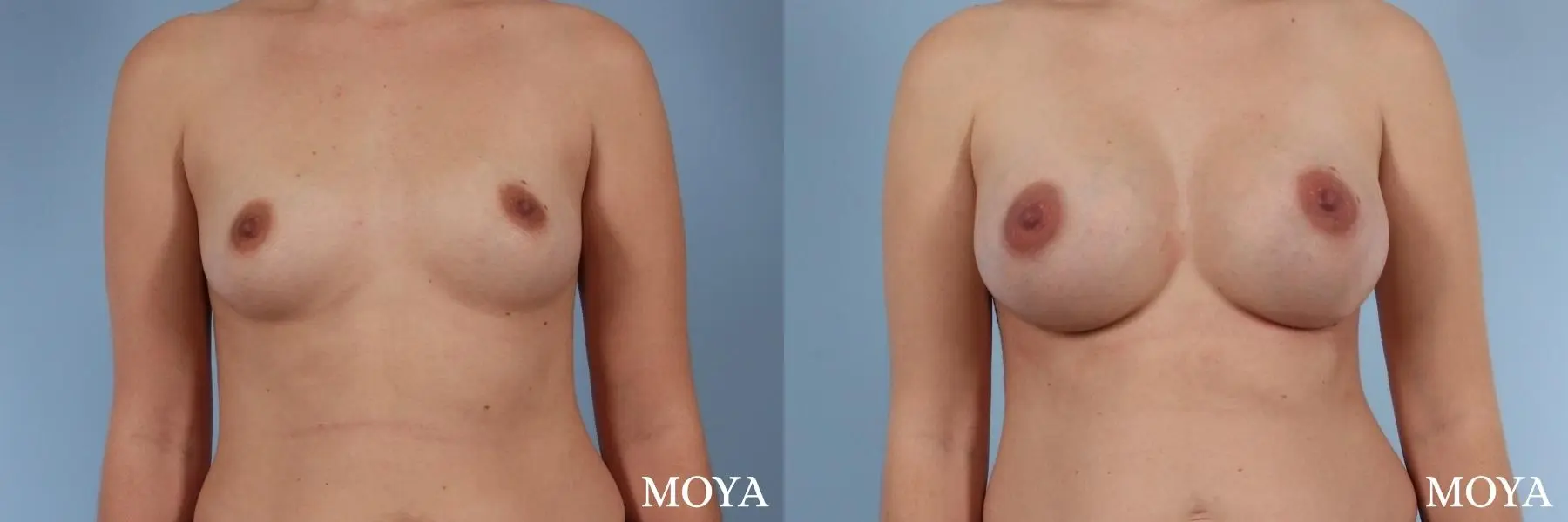 Breast Augmentation: Patient 8 - Before and After 1