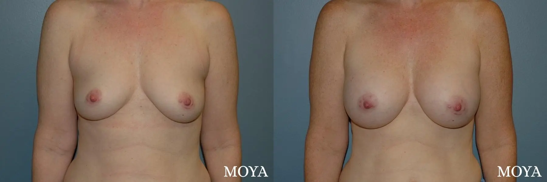 Breast Augmentation: Patient 11 - Before and After  