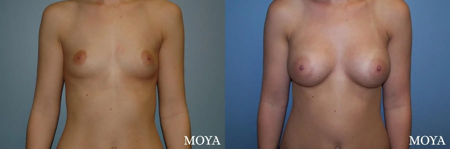 Breast Augmentation: Patient 6 - Before and After  
