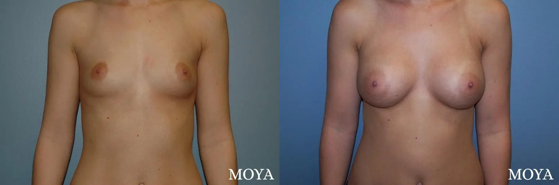 Breast Augmentation: Patient 6 - Before and After 1