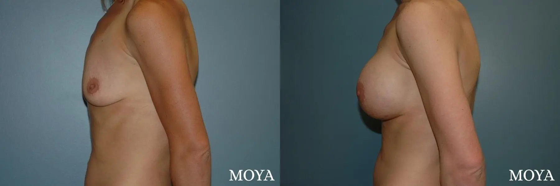 Breast Augmentation: Patient 10 - Before and After 2