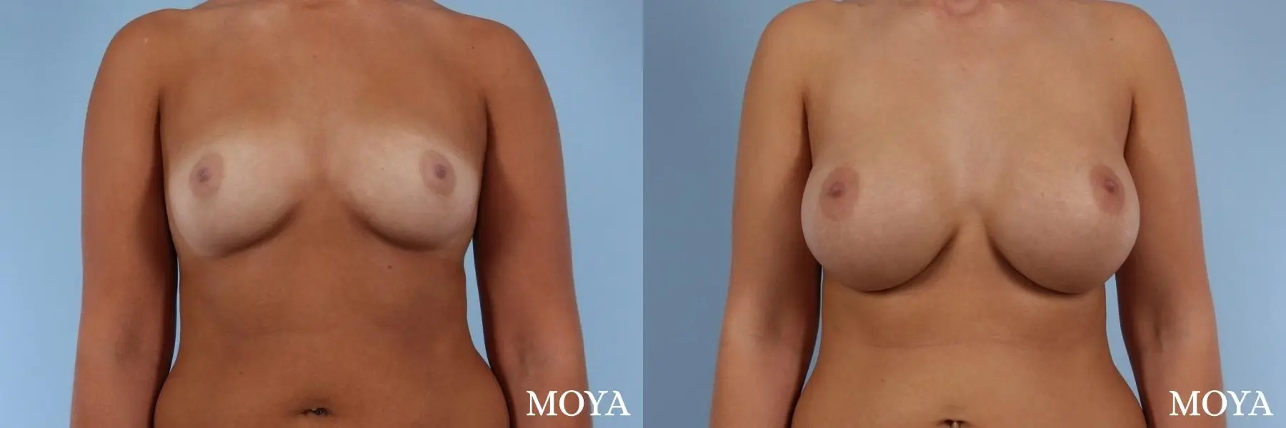 Breast Augmentation: Patient 5 - Before and After  