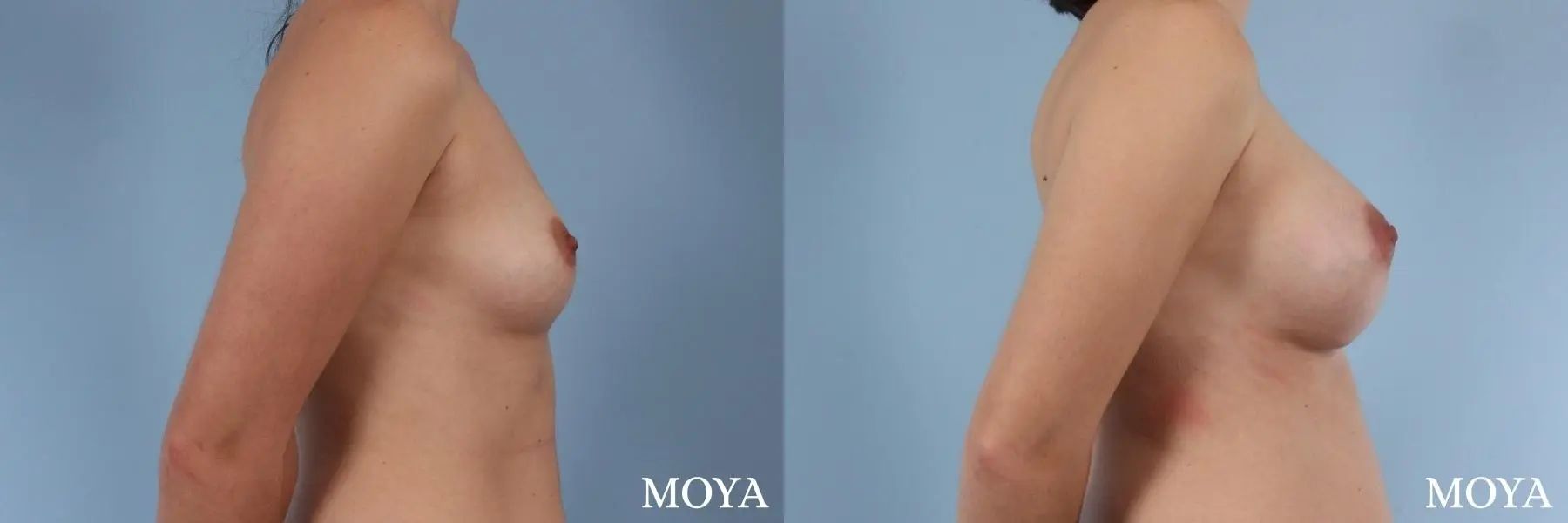 Breast Augmentation: Patient 8 - Before and After 2