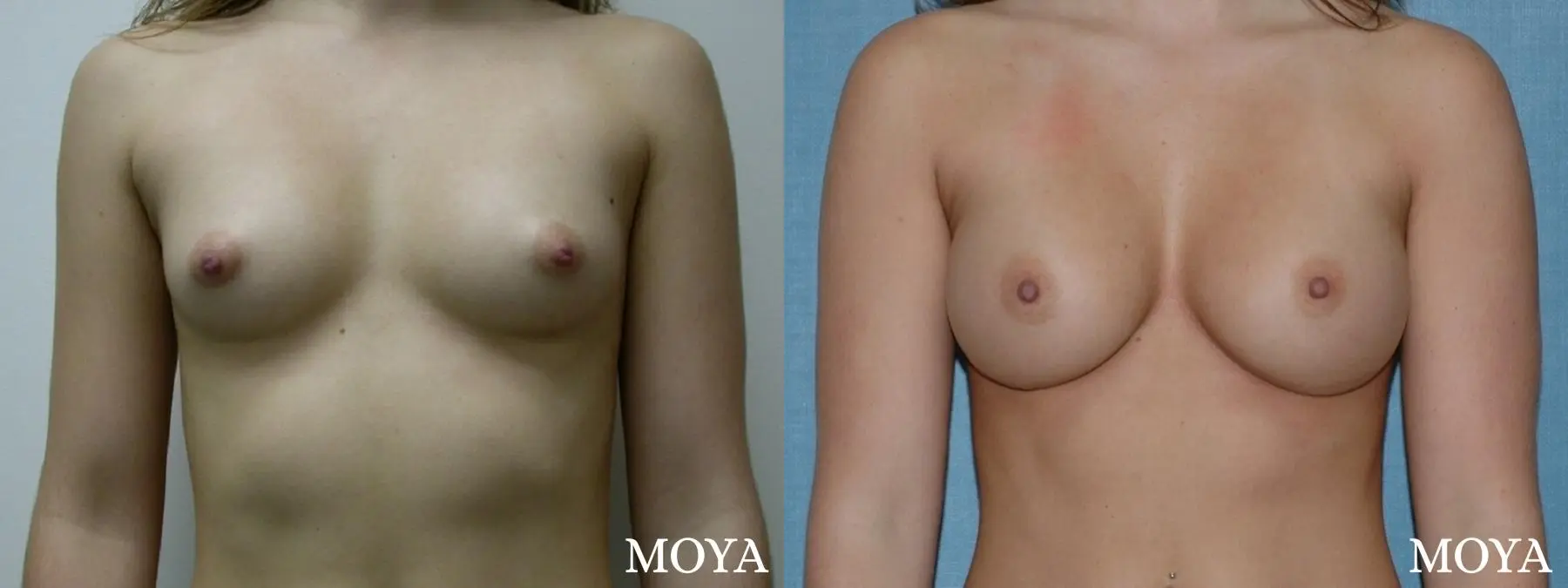 Breast Augmentation: Patient 1 - Before and After 1