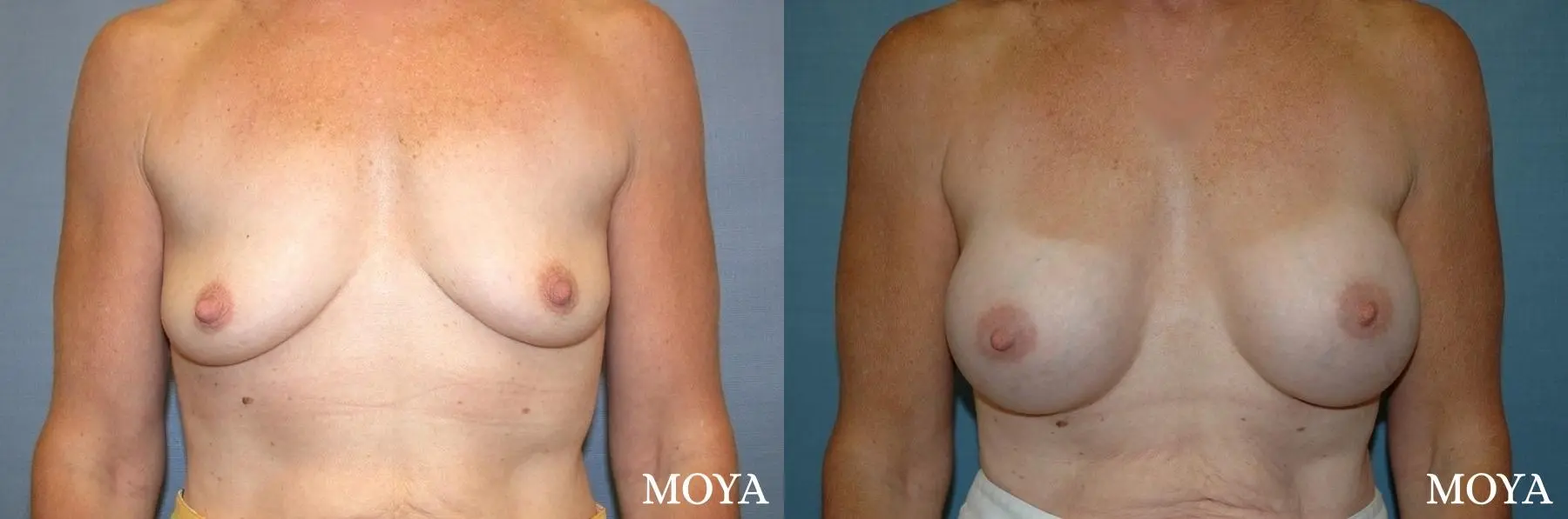 Breast Augmentation: Patient 4 - Before and After  