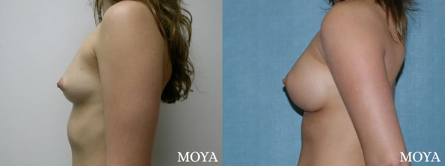 Breast Augmentation: Patient 1 - Before and After 2