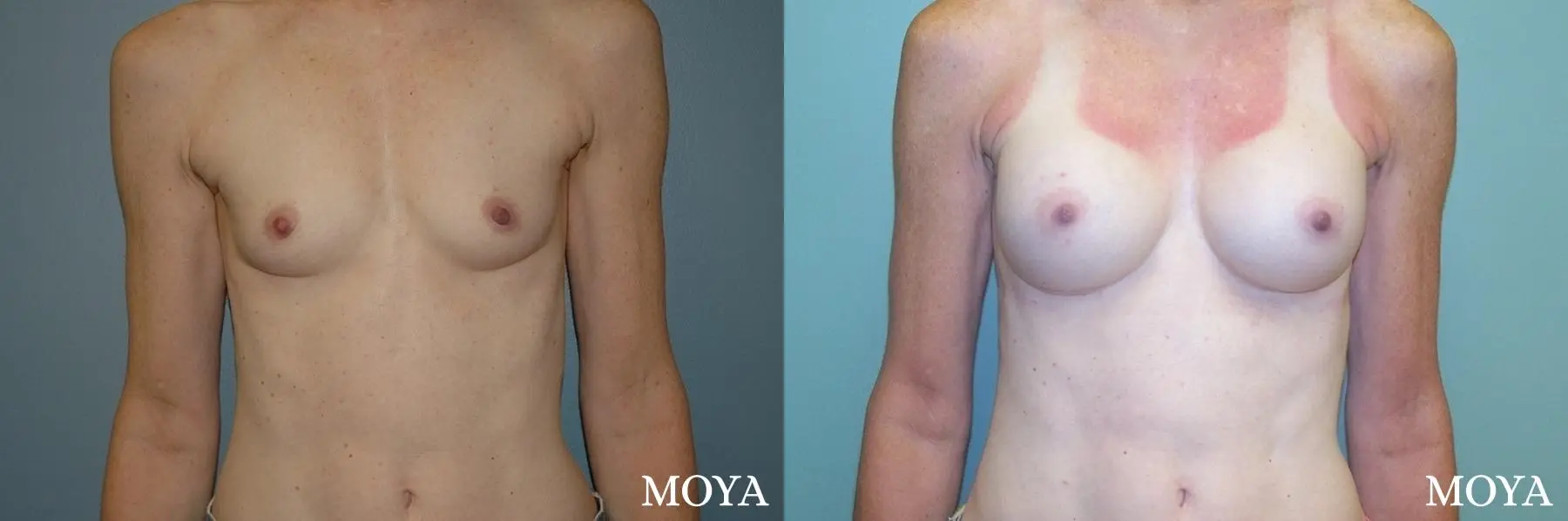 Breast Augmentation: Patient 12 - Before and After 1