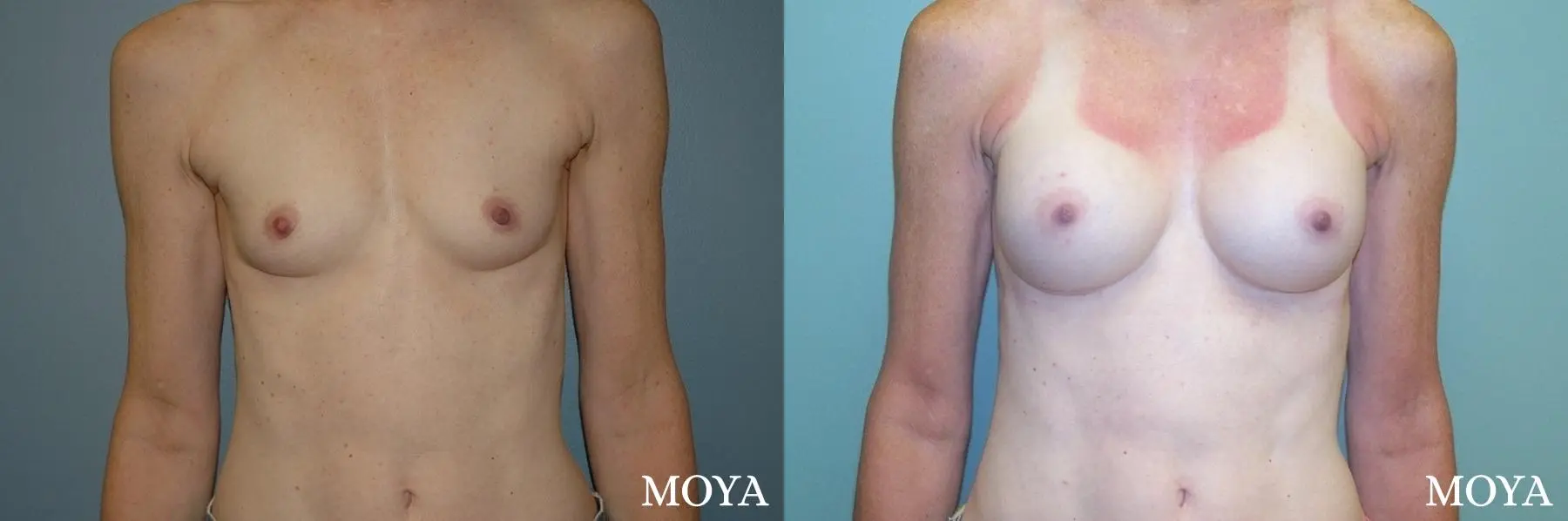 Breast Augmentation: Patient 12 - Before and After  