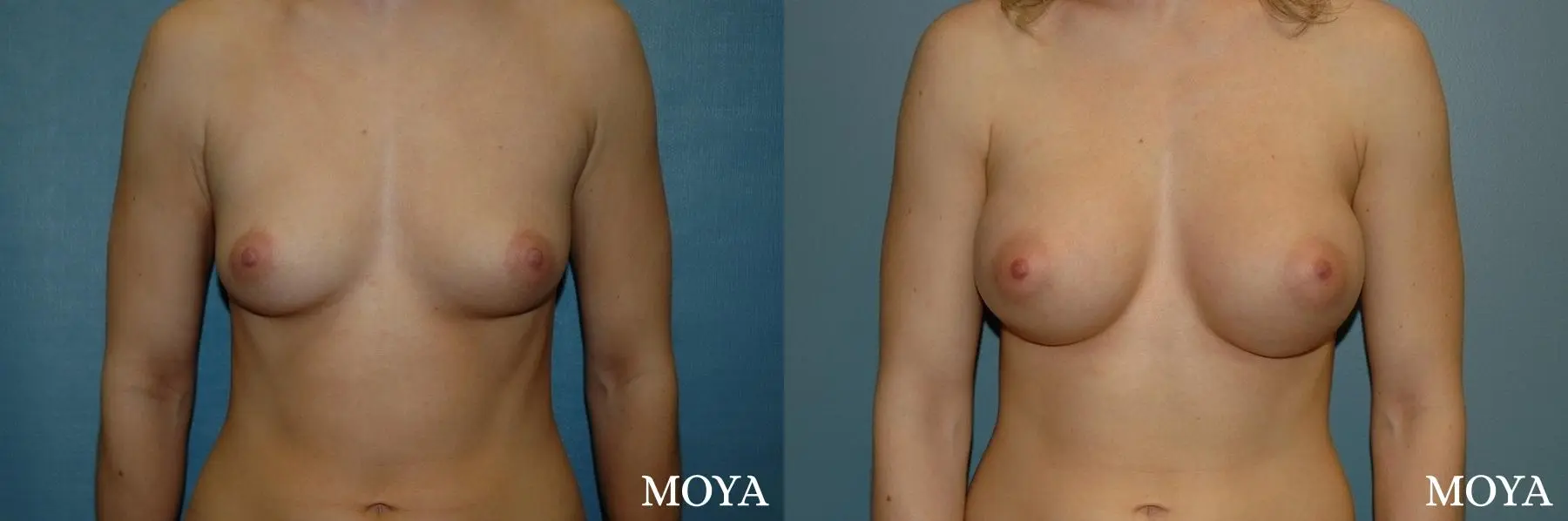 Breast Augmentation: Patient 3 - Before and After  