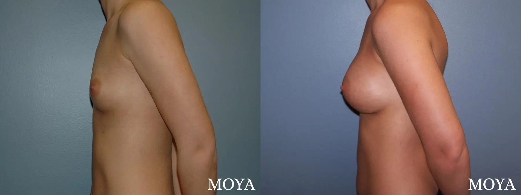 Breast Augmentation: Patient 6 - Before and After 2