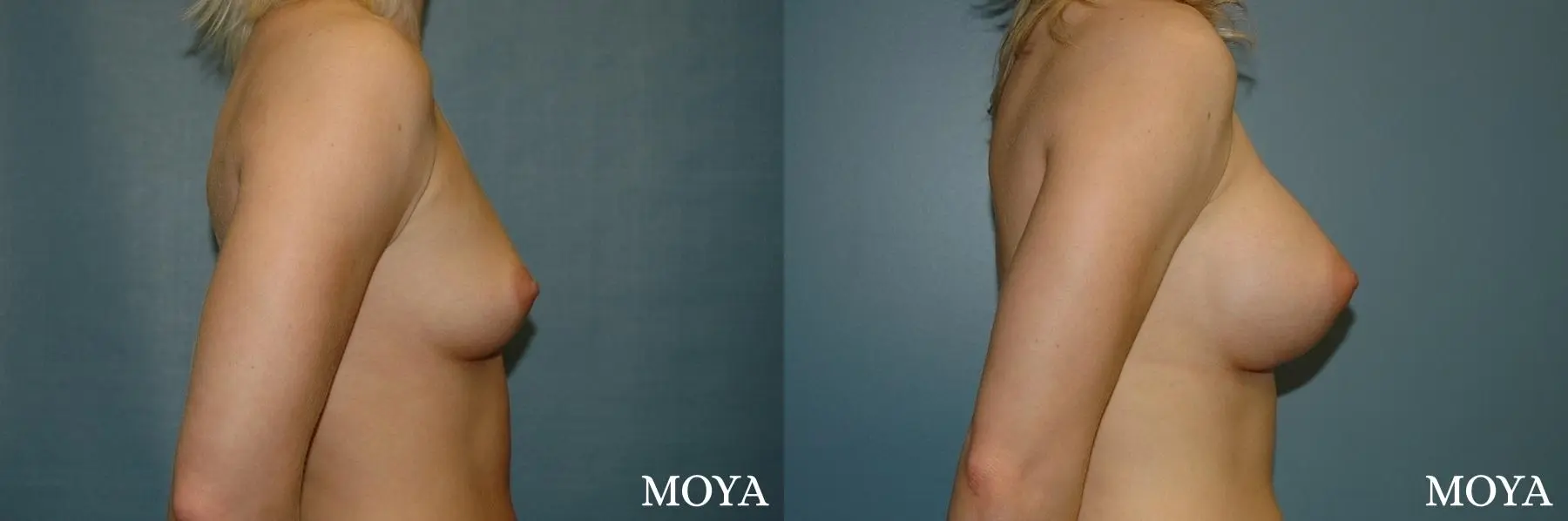 Breast Augmentation: Patient 3 - Before and After 2