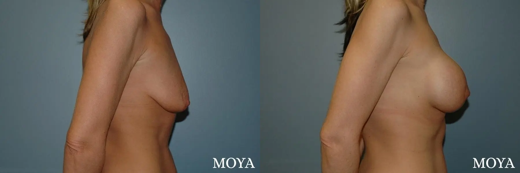 Breast Augmentation With Lift: Patient 2 - Before and After 2