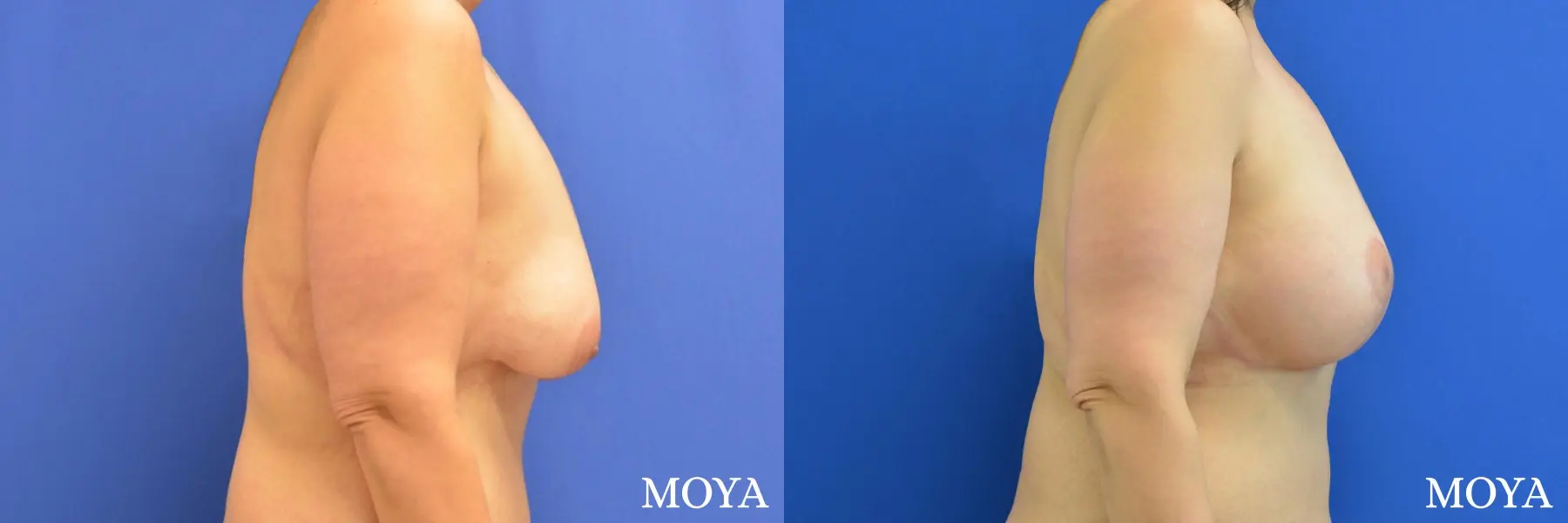 Breast Augmentation With Lift: Patient 10 - Before and After 2