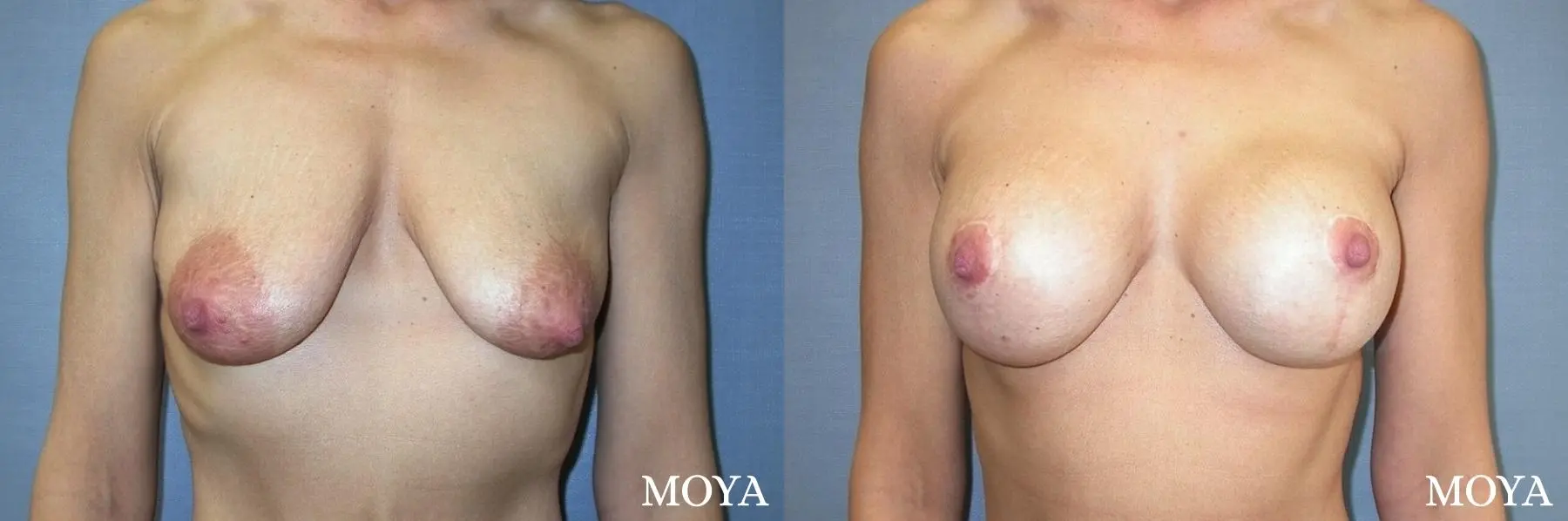 Breast Augmentation With Lift: Patient 4 - Before and After 1