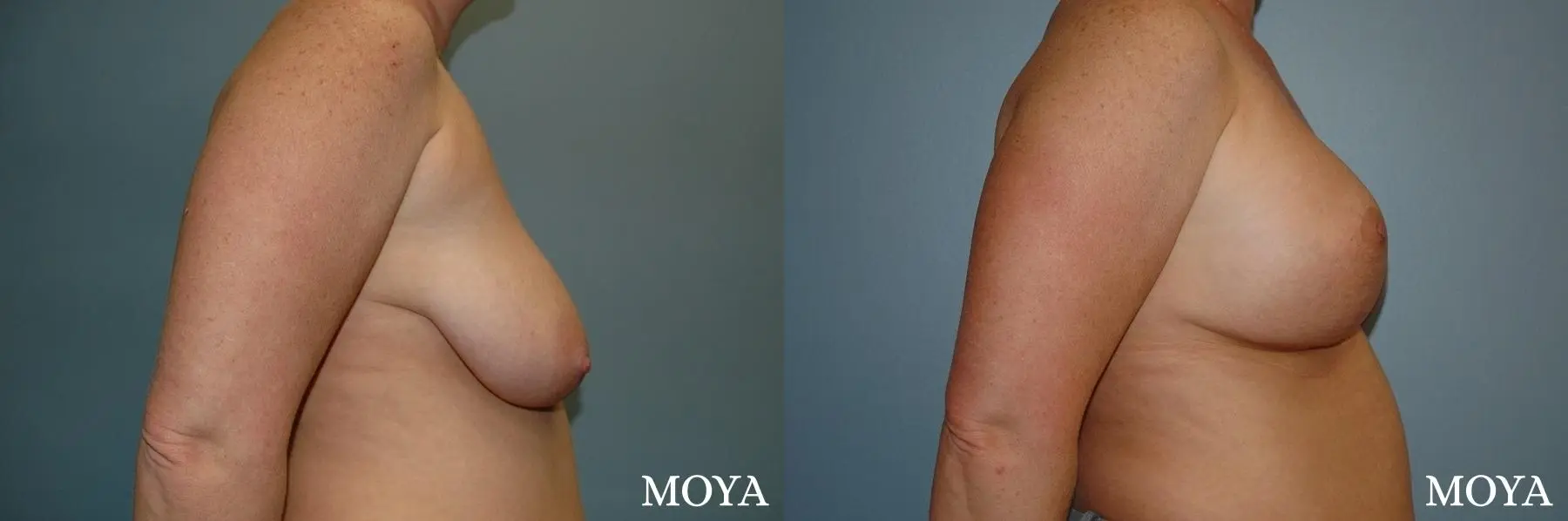 Breast Augmentation With Lift: Patient 9 - Before and After 2