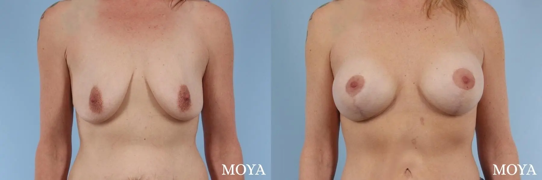 Breast Augmentation With Lift: Patient 12 - Before and After  