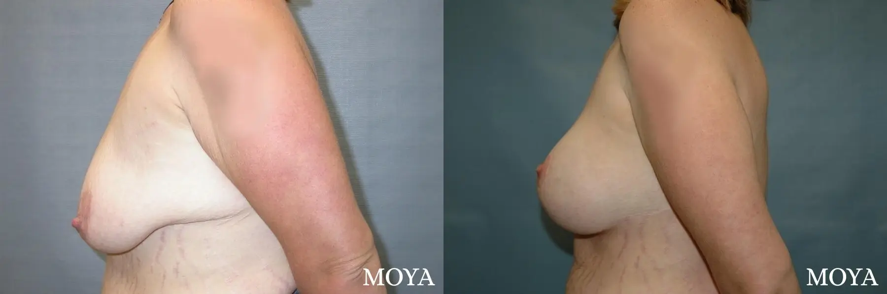 Breast Augmentation With Lift: Patient 5 - Before and After 2