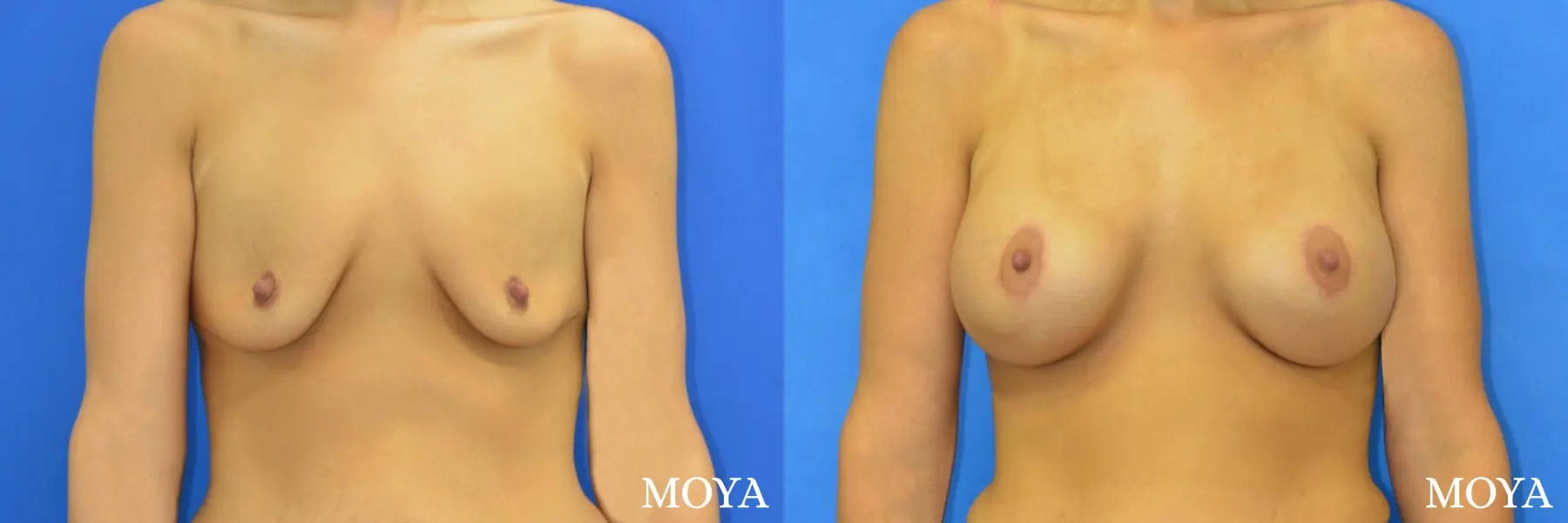 Breast Augmentation With Lift: Patient 1 - Before and After 1