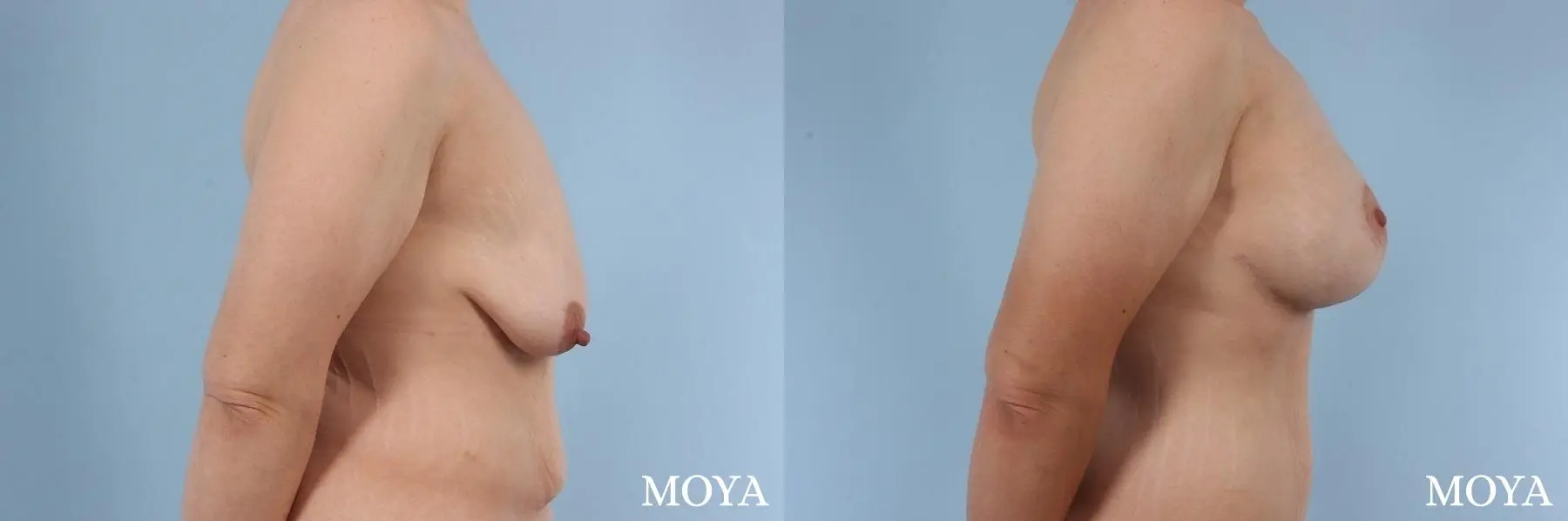 Breast Augmentation With Lift: Patient 6 - Before and After 2