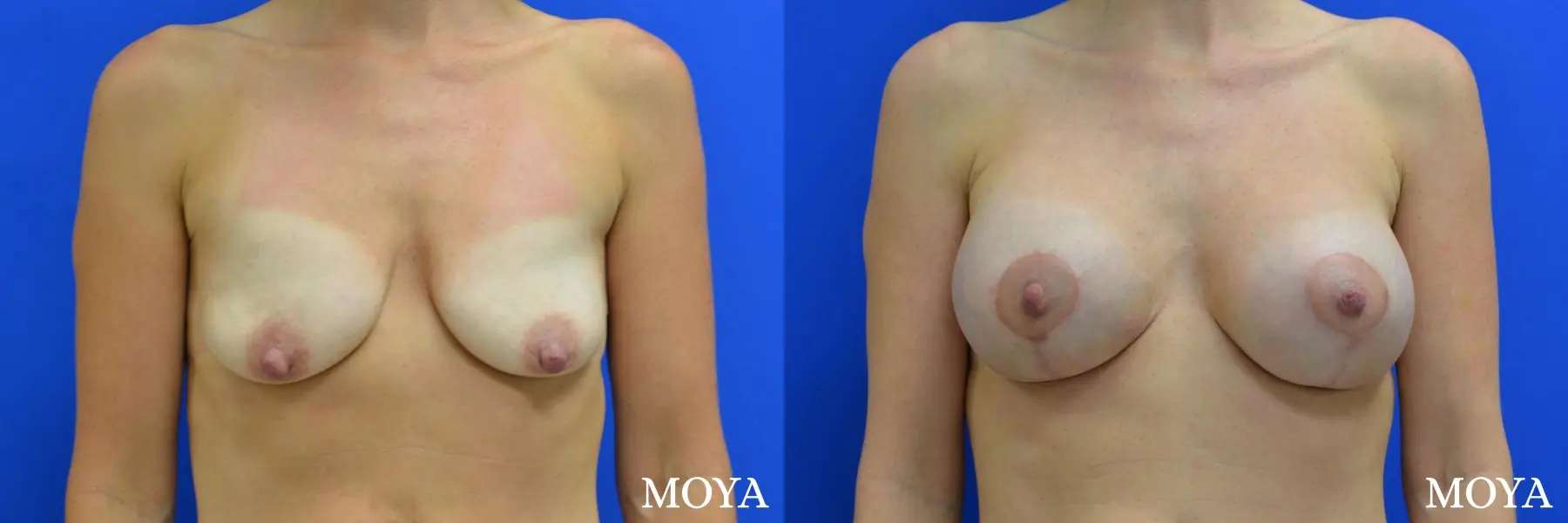 Breast Augmentation With Lift: Patient 7 - Before and After 1