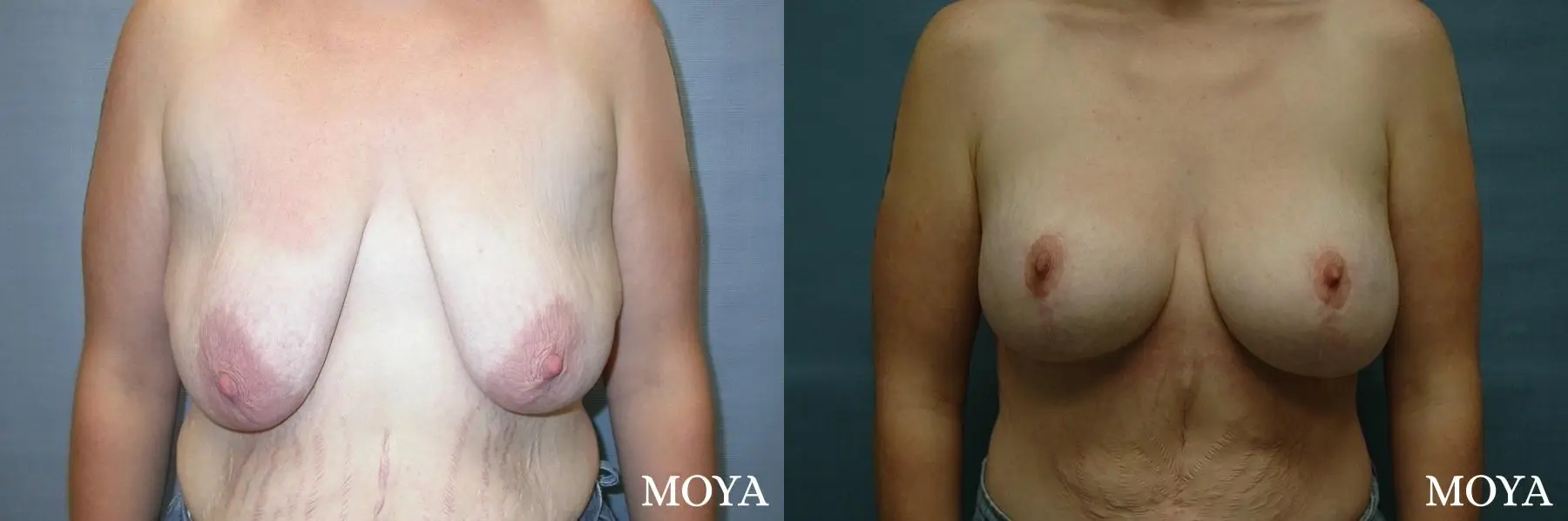 Breast Augmentation With Lift: Patient 5 - Before and After 1