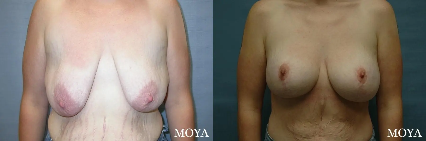 Breast Augmentation With Lift: Patient 5 - Before and After  