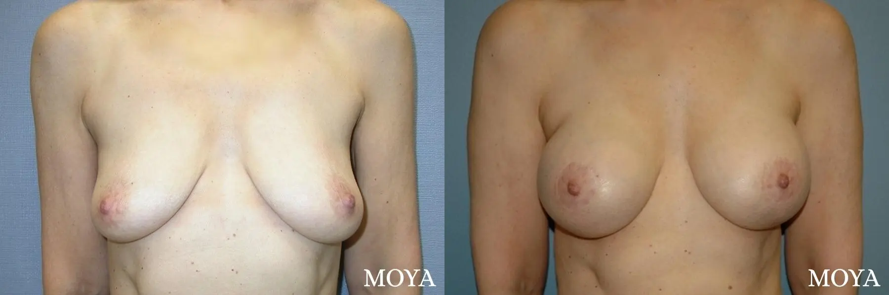 Breast Augmentation With Lift: Patient 3 - Before and After  
