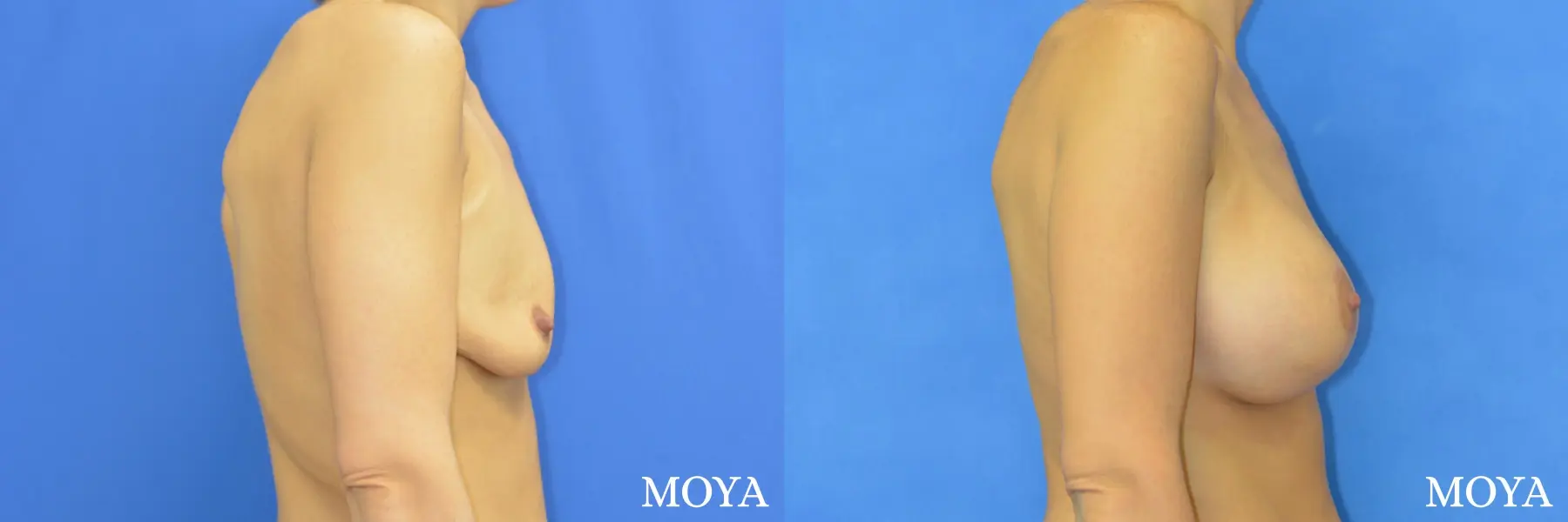 Breast Augmentation With Lift: Patient 1 - Before and After 2
