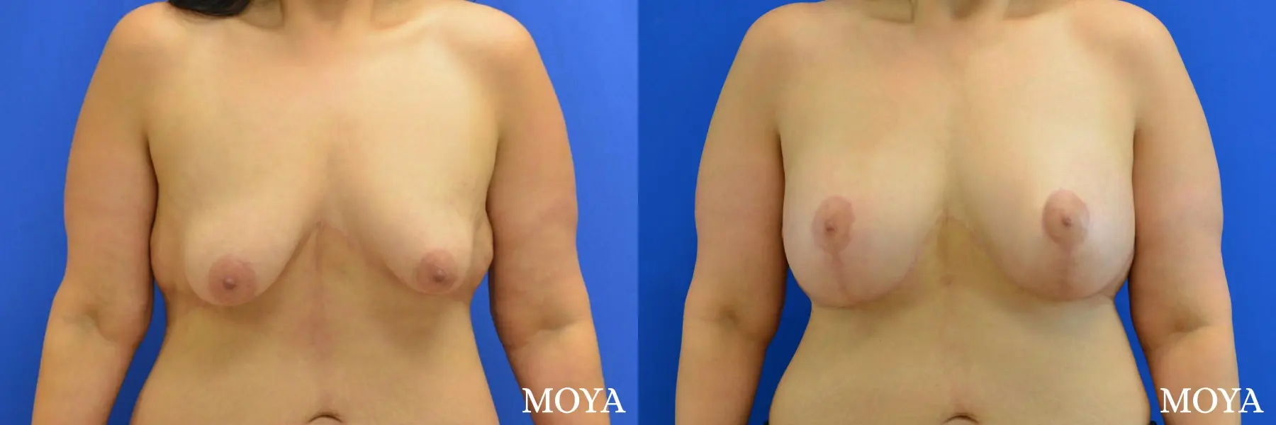 Breast Augmentation With Lift: Patient 10 - Before and After  